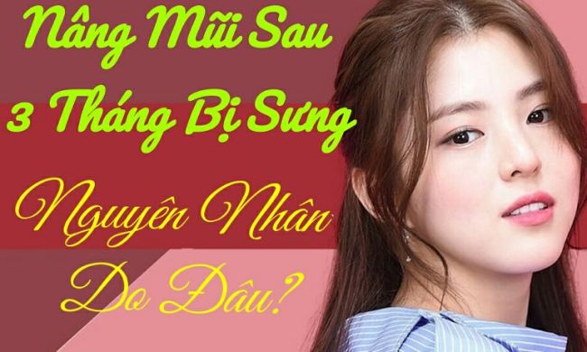 Nâng mũi sau 3 tháng bị sưng: Bác sĩ chỉ rõ nguyên nhân