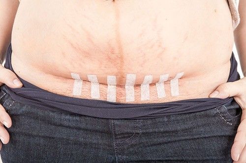 Giải đáp: Sinh mổ bao lâu thì vết thương bên trong lành?