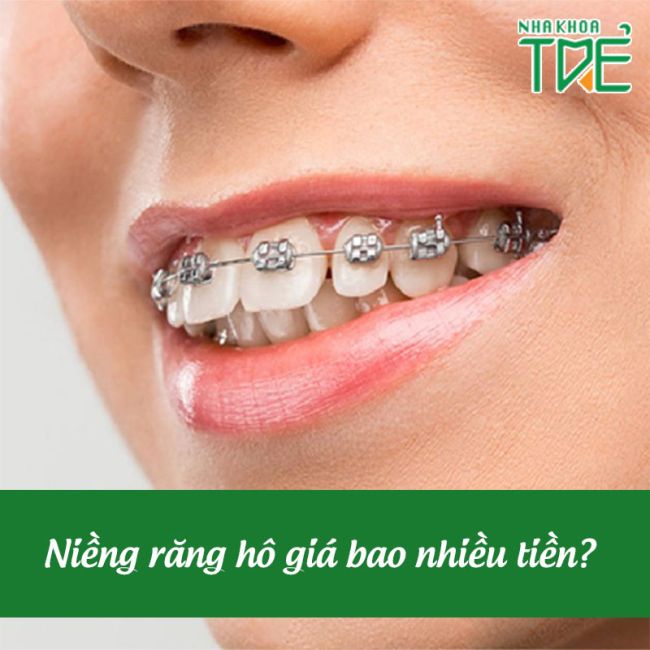Giá niềng răng hô hàm trên bao nhiêu tiền? Bảng giá mới nhất