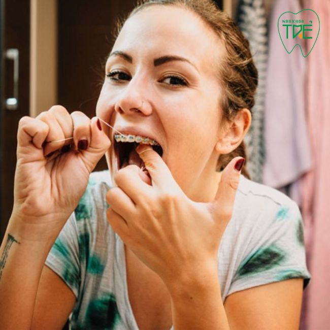 Dùng chỉ nha khoa khi niềng răng: Lợi ích và cách dùng chuẩn