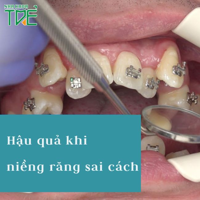 Cảnh báo 6 hậu quả niềng răng sai cách và cách phòng ngừa