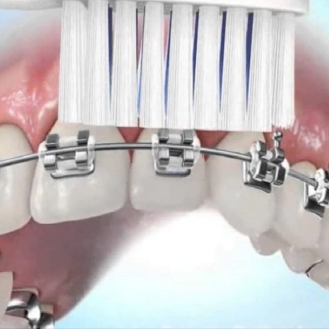 Hướng dẫn 5 cách vệ sinh răng miệng cho người niềng răng
