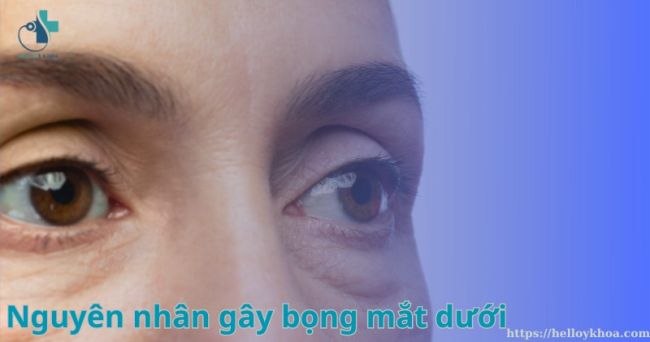 11 nguyên nhân gây bọng mắt dưới bạn có biết - Hình thành thế nào?