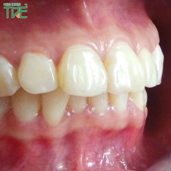 Răng hô nhẹ là thế nào? Hô nhẹ có nên niềng không?