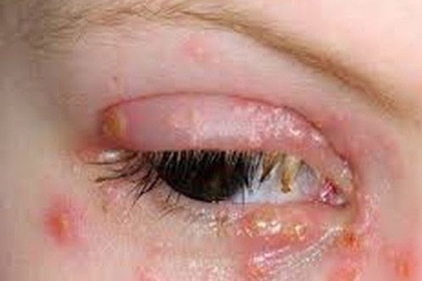 Những thông tin về bệnh lậu mắt mà bạn không nên bỏ qua
