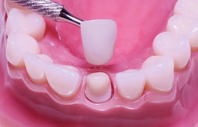 Khi nào nên bọc răng sứ hàm dưới và cần lưu ý điều gì?