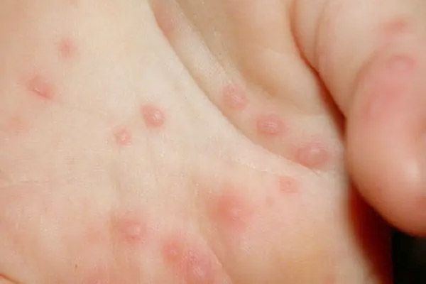 Bệnh giang mai giai đoạn 2: Dấu hiệu, cách điều trị