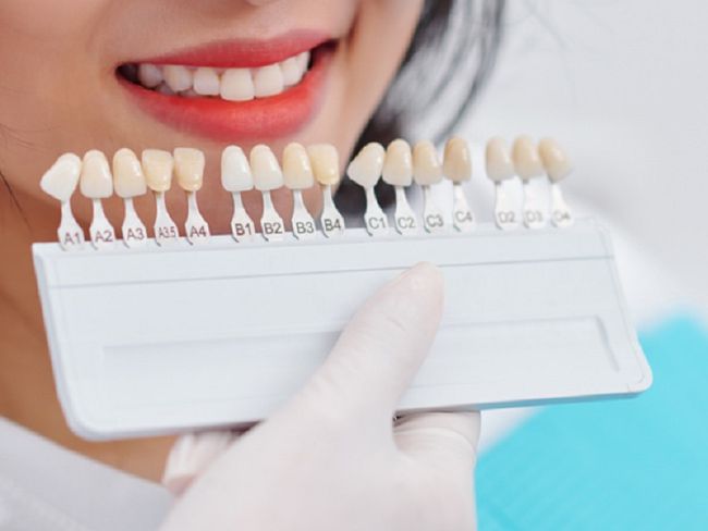 Bọc răng sứ có bị xuống màu không? Cách giữ màu răng bền đẹp?