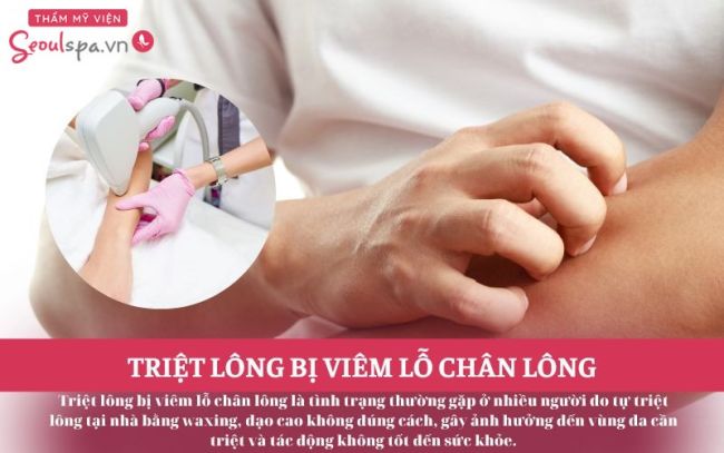 Triệt lông bị viêm lỗ chân lông: Nguyên nhân và cách điều trị