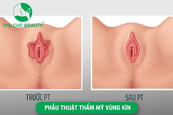 Phẫu thuật thẩm mỹ vùng kín: Lợi ích và đối tượng nên thực hiện - Bệnh viện Thẩm mỹ Thu Cúc