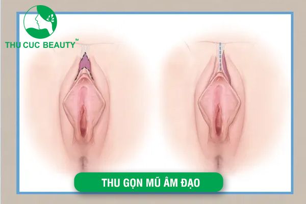 Thu gọn mũ âm vật: Cách thực hiện và chăm sóc đúng chuẩn