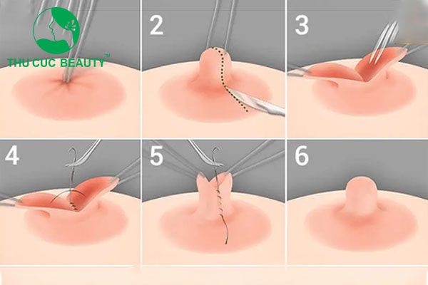 Kéo núm vú tụt - Bệnh viện Thẩm mỹ Thu Cúc