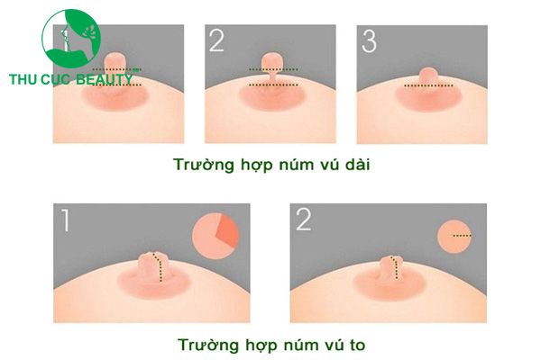 Thu Gọn Núm Vú: Phẫu thuật thu nhỏ đầu ti an toàn