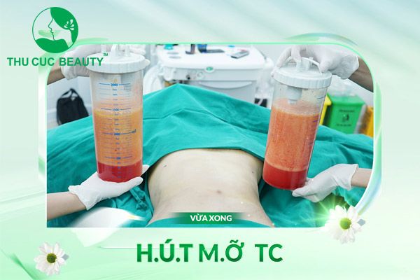 Hút mỡ 3 vùng - Bệnh viện Thẩm mỹ Thu Cúc