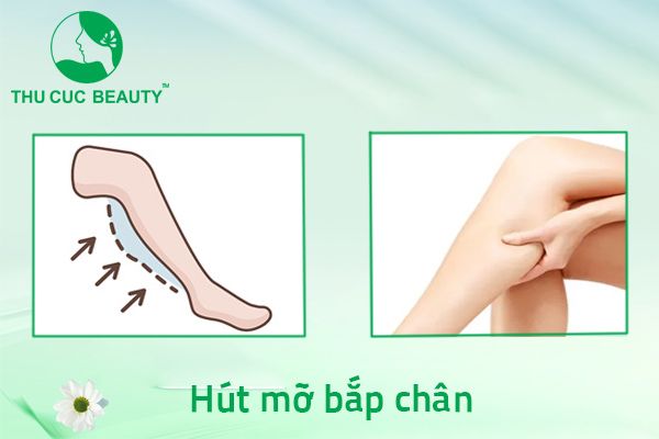 Hút mỡ bắp chân - Bệnh viện Thẩm mỹ Thu Cúc