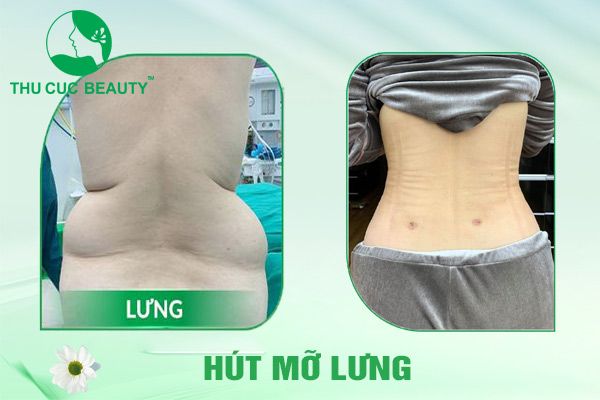 Hút mỡ lưng - Bệnh viện Thẩm mỹ Thu Cúc