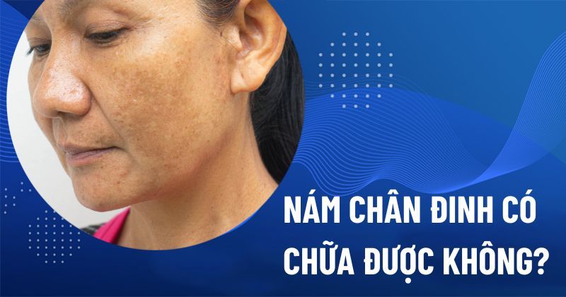 Nám chân đinh có chữa được không? Đâu là giải pháp tốt nhất?