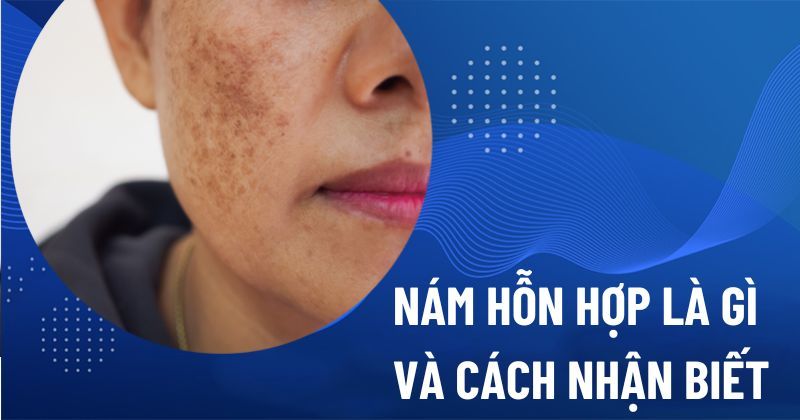 Nám hỗn hợp là gì? Hình ảnh nhận biết, nguyên nhân và trị liệu