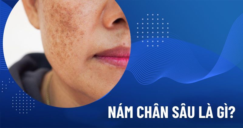 Nám chân sâu là gì? Nguyên nhân, cách nhận biết và giải pháp trị liệu