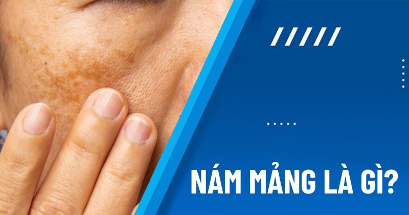 Nám mảng là gì? Dấu hiệu, tác nhân gây nám và cách phòng ngừa