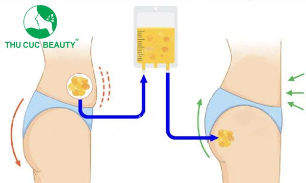 Nâng mông bằng cấy mỡ tự thân - Bệnh viện Thẩm mỹ Thu Cúc