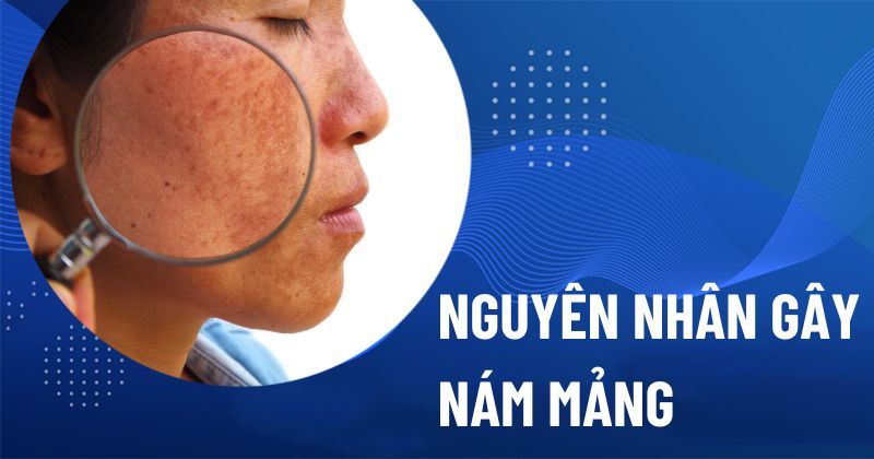 9 nguyên nhân gây nám mảng do đâu? Giải pháp phòng ngừa và điều trị