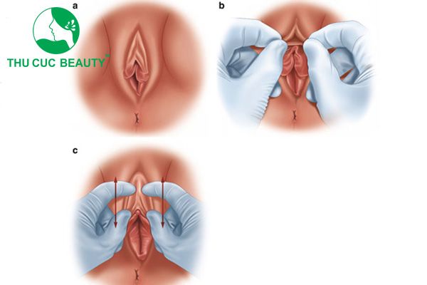 thu gọn mũ âm vật