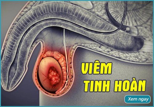 Viêm tinh hoàn - Tất cả những thông tin quan trọng