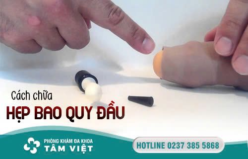 Cách chữa hẹp bao quy đầu hiện nay - Phòng Khám Đa Khoa Tâm Việt Thanh Hóa