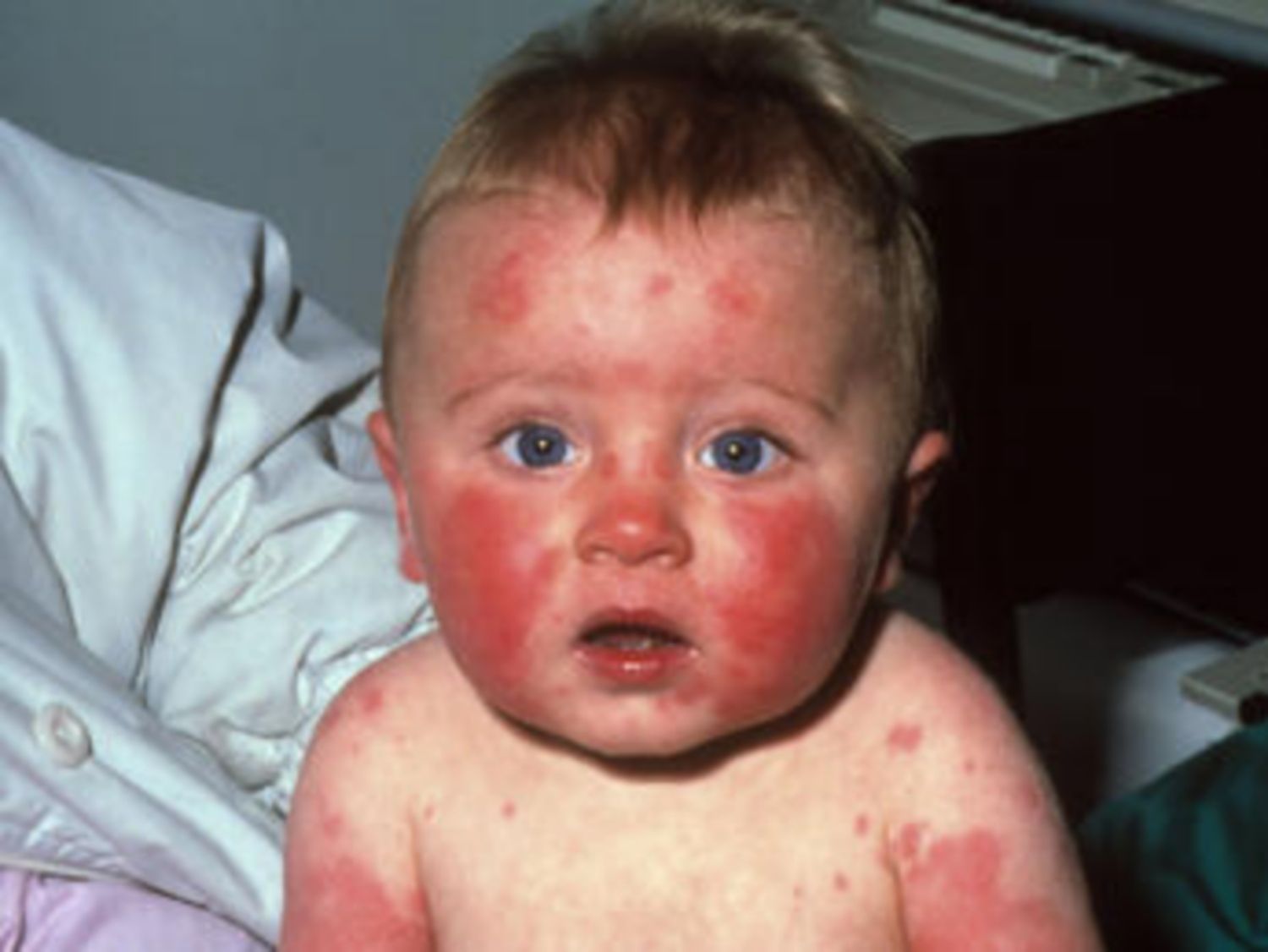 Bệnh ban đỏ nhiễm khuẩn do parvovirus B19 trong thai kỳ