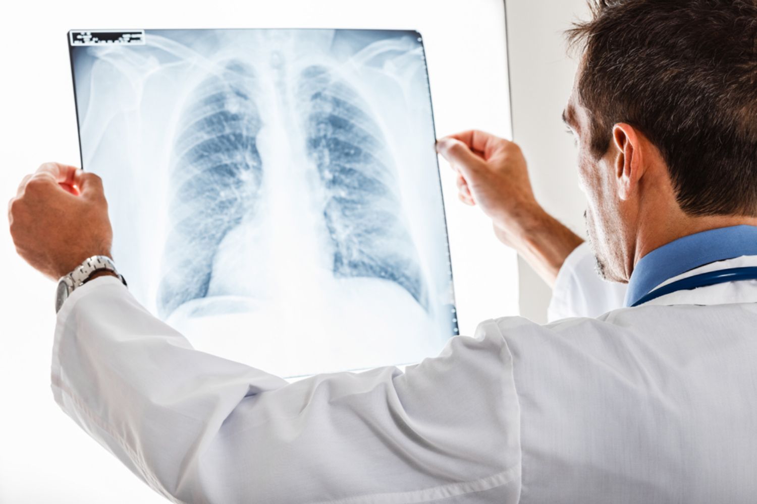Chẩn đoán và điều trị ung thư phổi: những điều cần biết