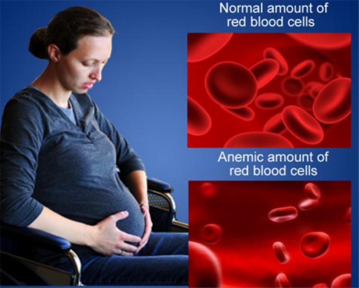 Thiếu máu do thiếu sắt khi mang thai
