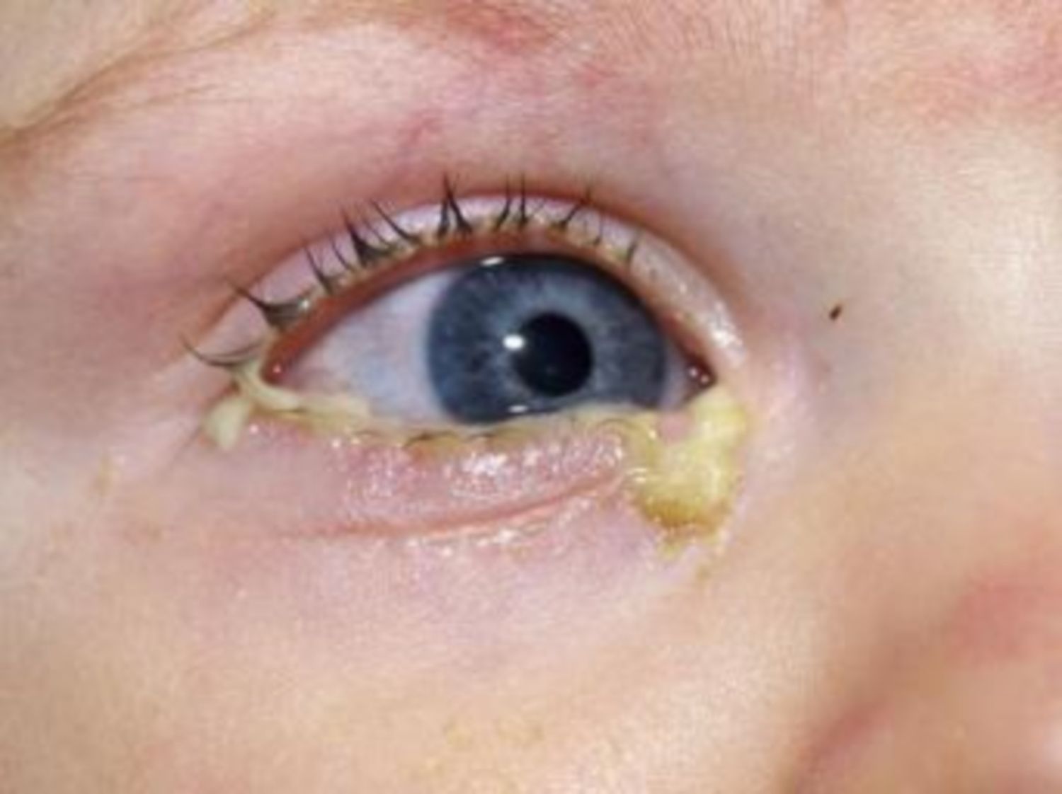 Đau mắt đỏ (viêm kết mạc) ở trẻ nhỏ