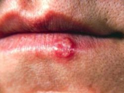 Tình trạng rộp môi (Herpes môi) là thế nào?