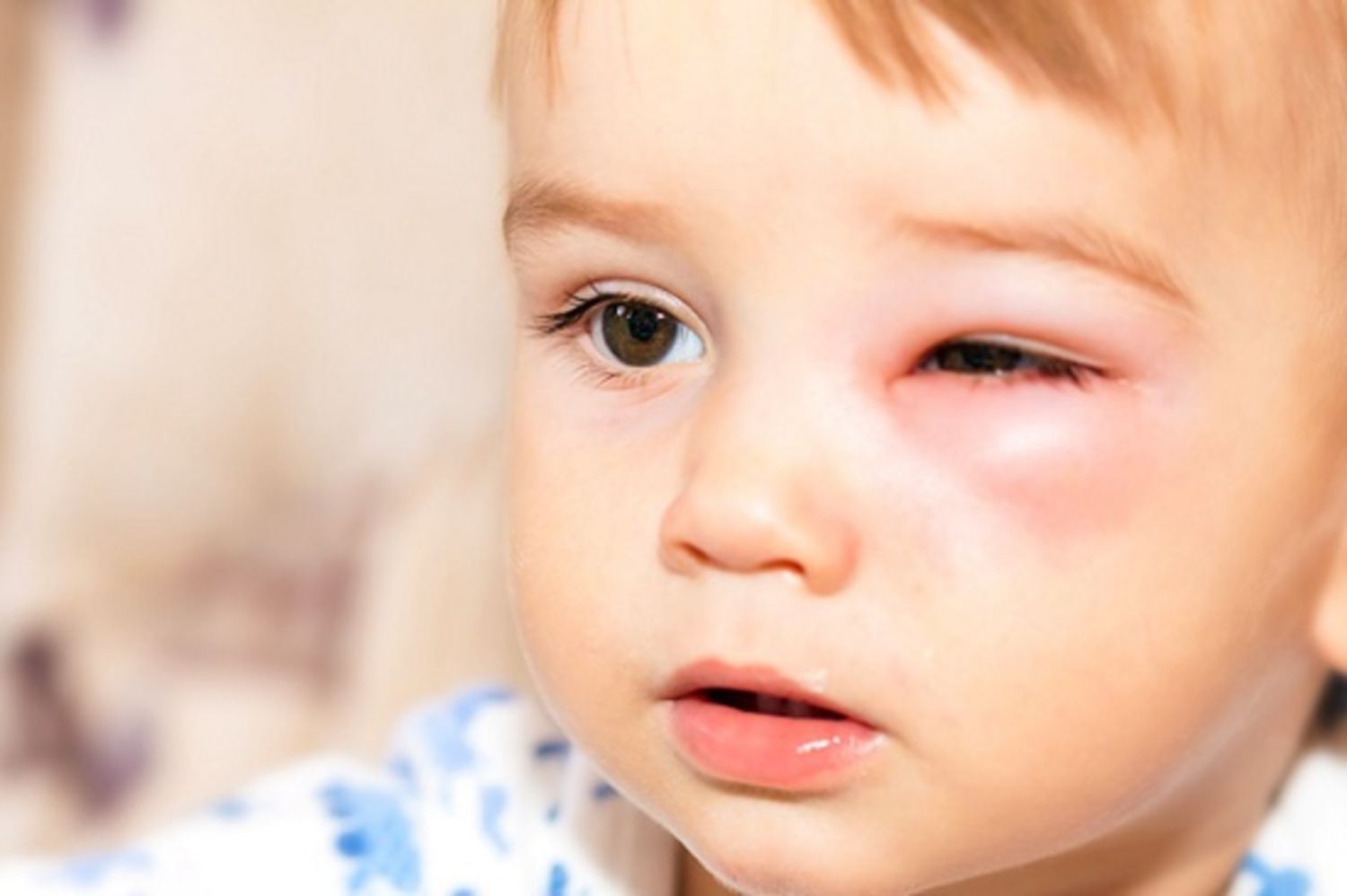 Viêm tế bào ổ mắt ở trẻ em