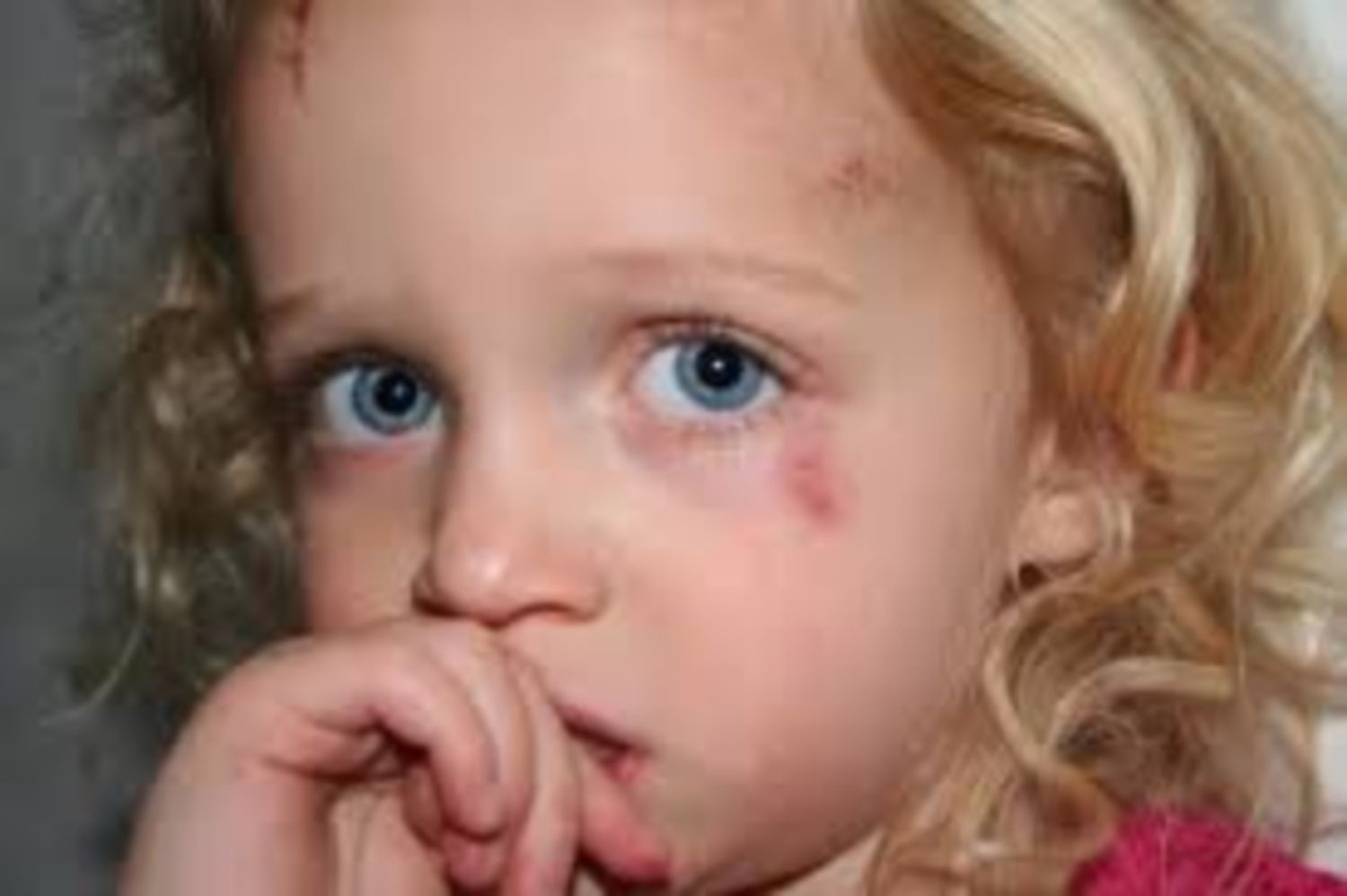 Điều gì làm tăng nguy cơ trẻ 6 tuổi bị thâm quầng mắt?
