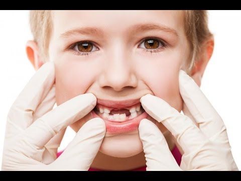 9 yếu tố gây nguy cơ mất răng