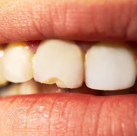 Các mẹo ngăn ngừa tổn thương răng miệng