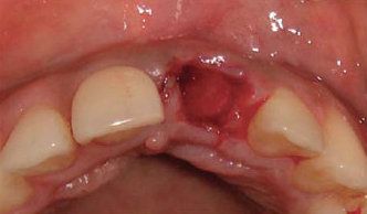 Bệnh viêm ổ răng khô- nguyên nhân và điều trị
