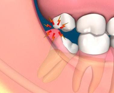 Bệnh viêm quanh thân răng (pericoronitis)