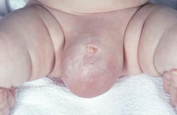 Sưng tinh hoàn ở bé trai