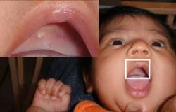 Những triệu chứng cho thấy bé bị viêm nướu và miệng