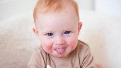 Dị ứng ở trẻ sơ sinh