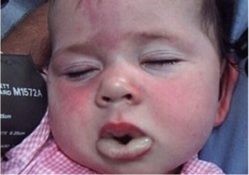 Sốc phản vệ ở trẻ sơ sinh và trẻ nhỏ