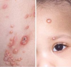 Bệnh u mềm lây ở trẻ em