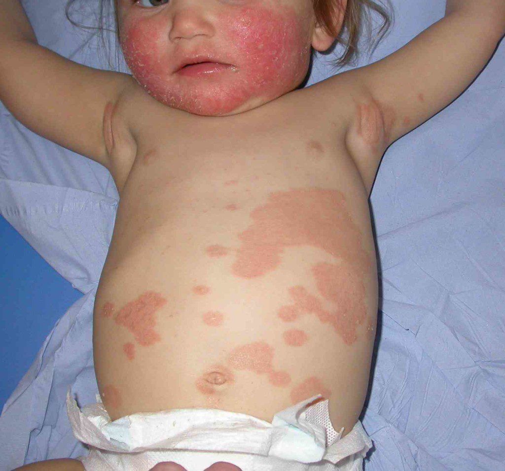 Bệnh vảy phấn trắng ở trẻ sơ sinh