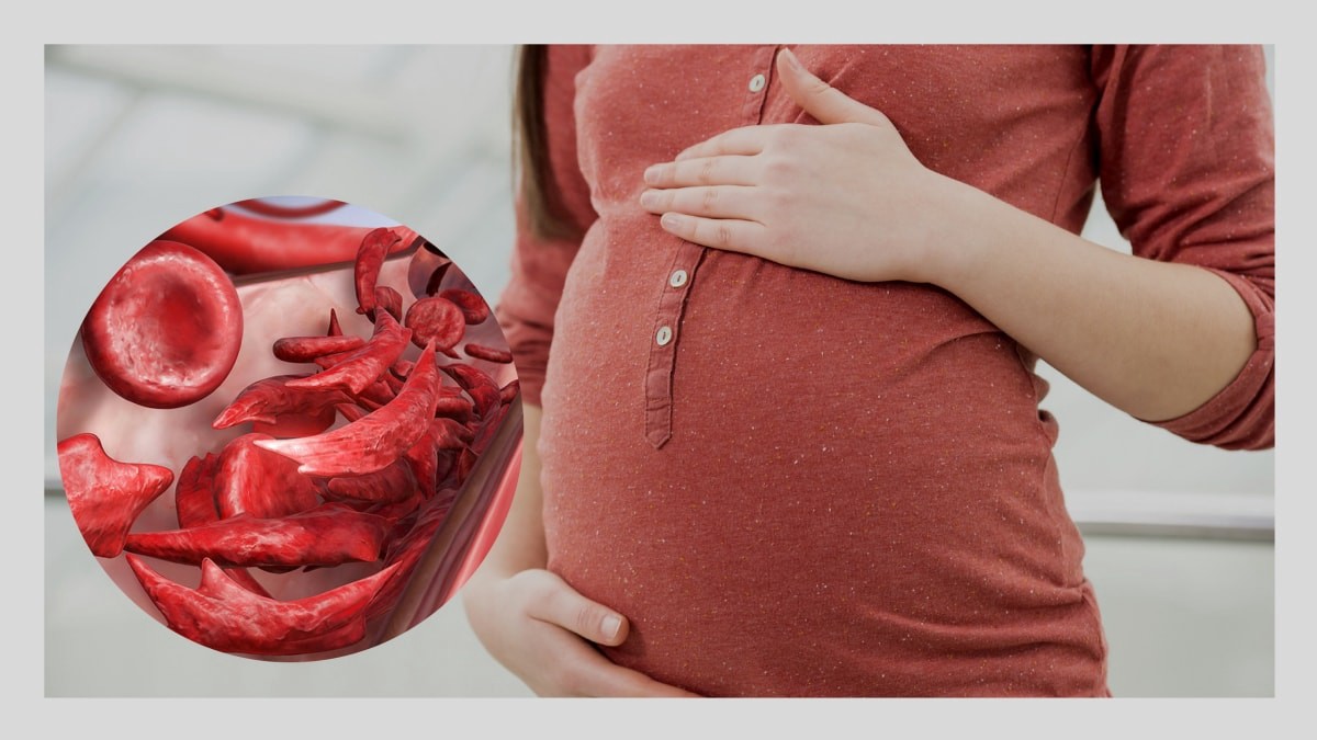 Bà bầu bị bệnh hồng cầu hình liềm ảnh hưởng đến thai nhi như thế nào?