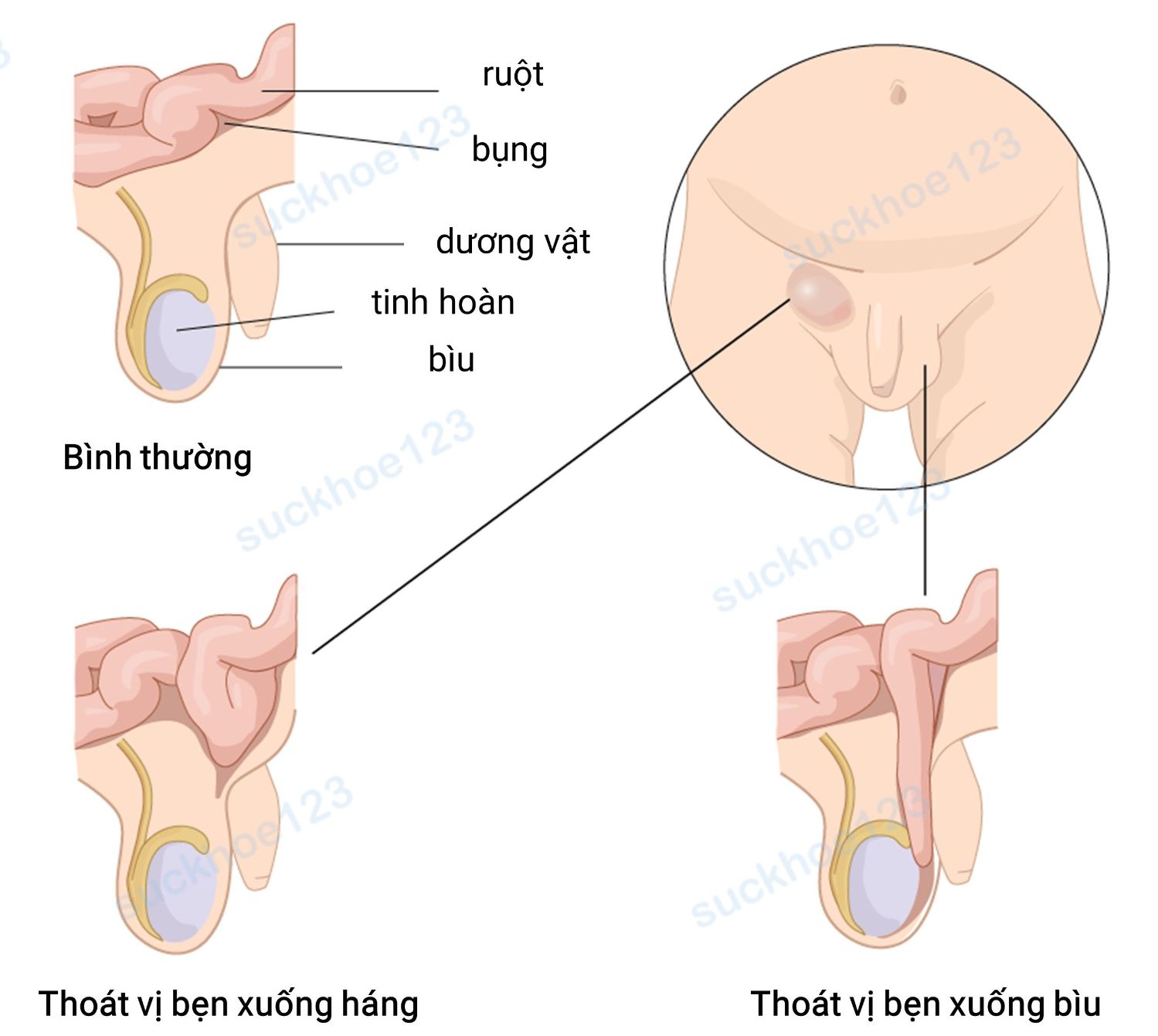 thoát vị bẹn