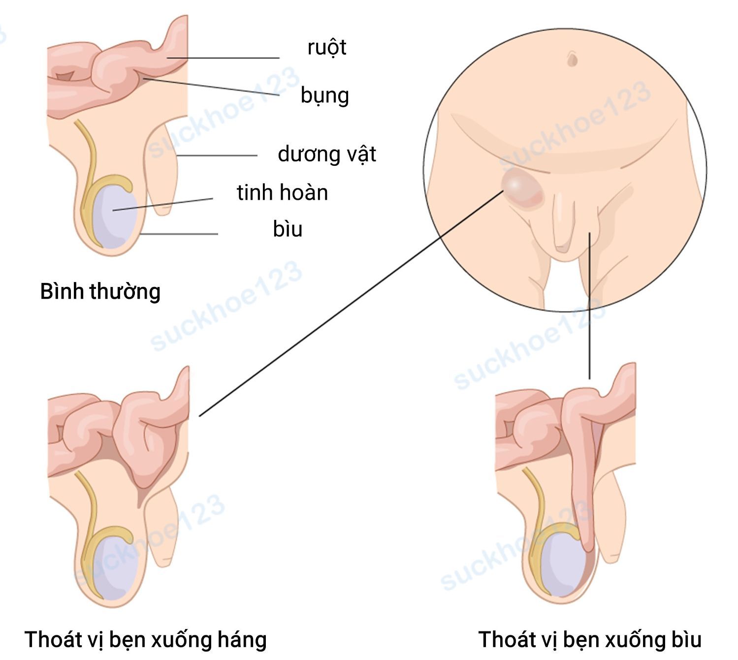 thoát vị bẹn