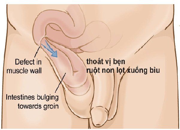 Các tác nhân gây sưng bìu ở trẻ em